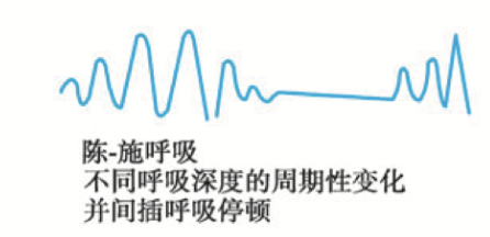 Cheyne-Stokes呼吸示意图