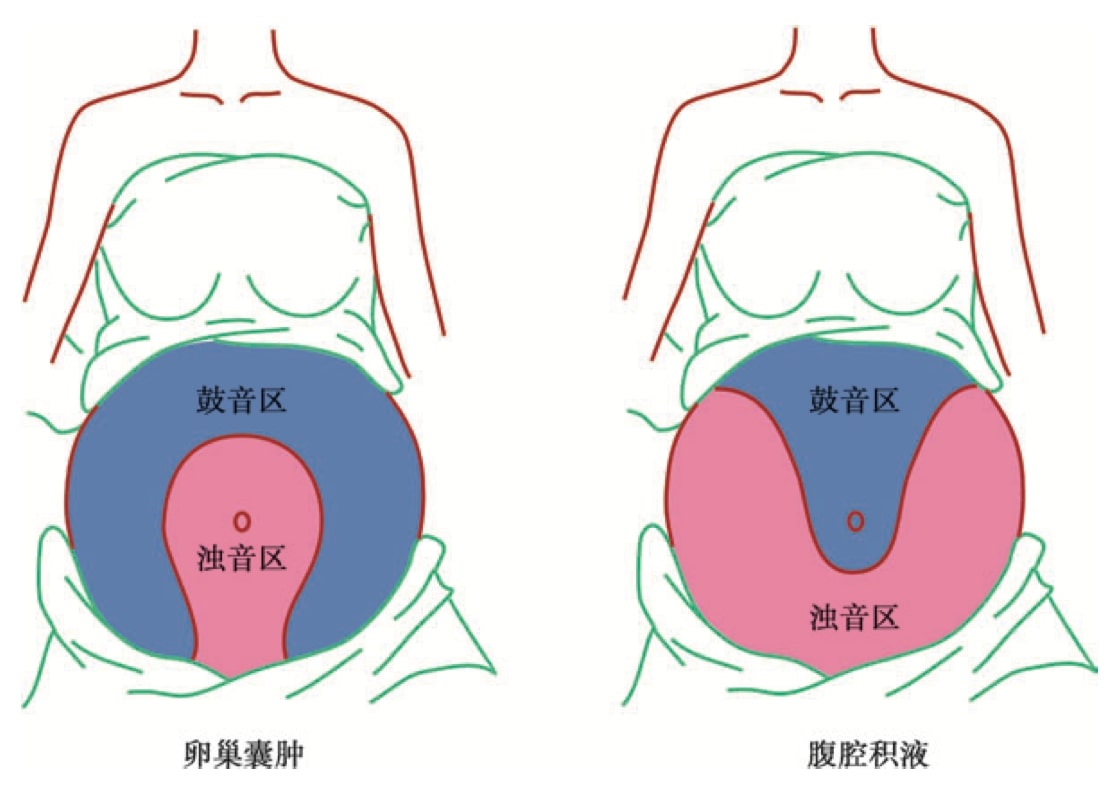 卵巢囊肿与腹腔积液鉴别示意图(尺压试验)
