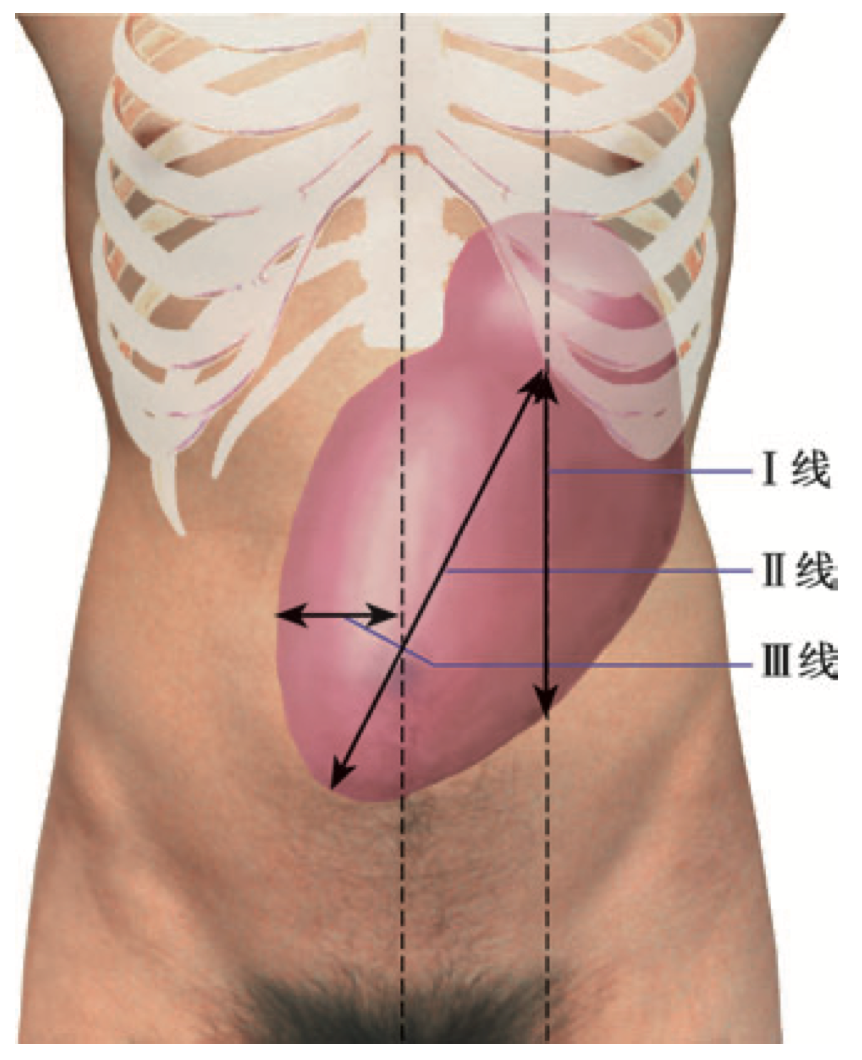 脾脏肿大测量示意图